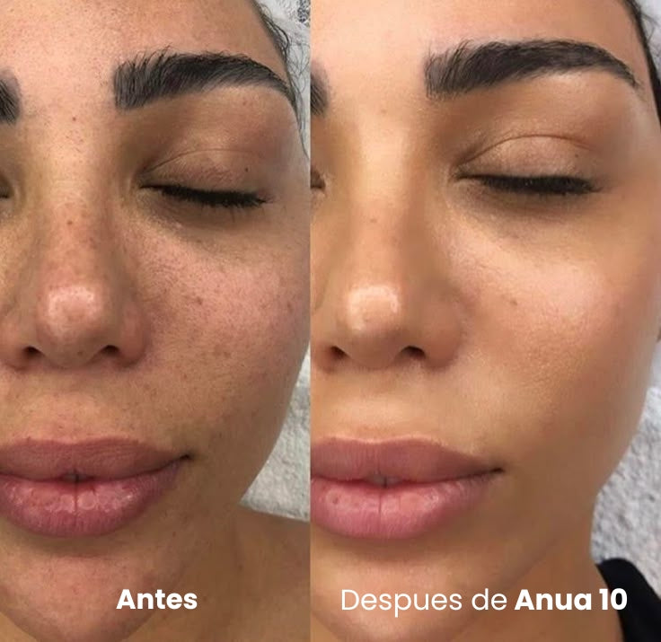 Sérum Coreano Anua 10 — Desvanece Manchas y Empareja el Tono
