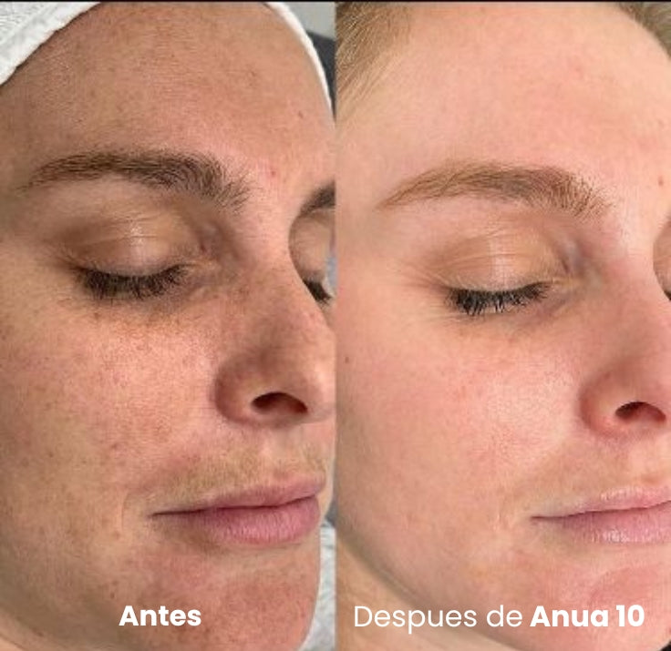 Sérum Coreano Anua 10 — Desvanece Manchas y Empareja el Tono