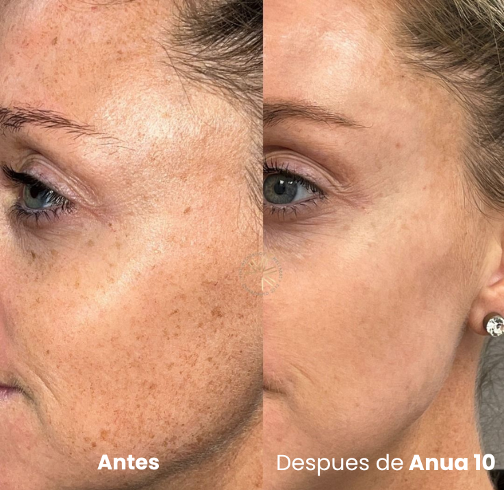 Sérum Coreano Anua 10 — Desvanece Manchas y Empareja el Tono